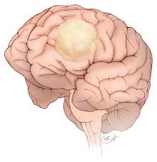 /Brain tumors